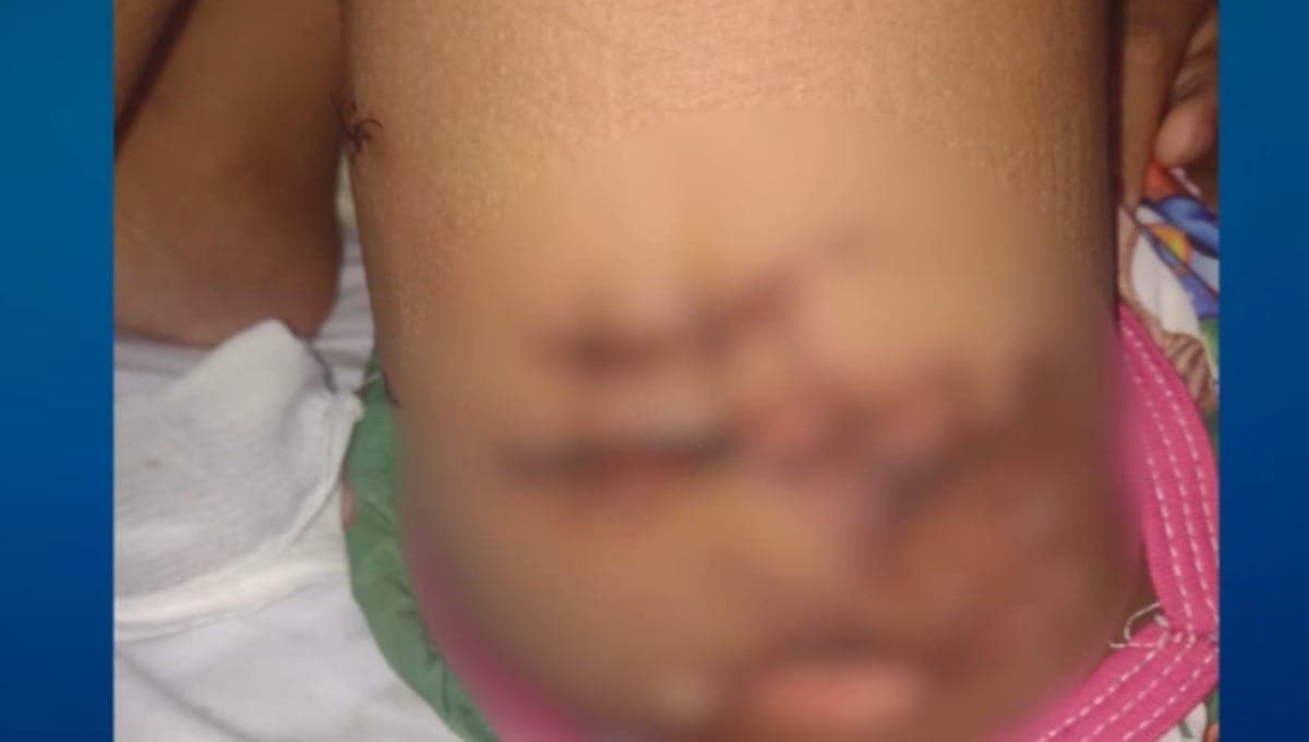 Menina foi atacada por pitbull em Campinas