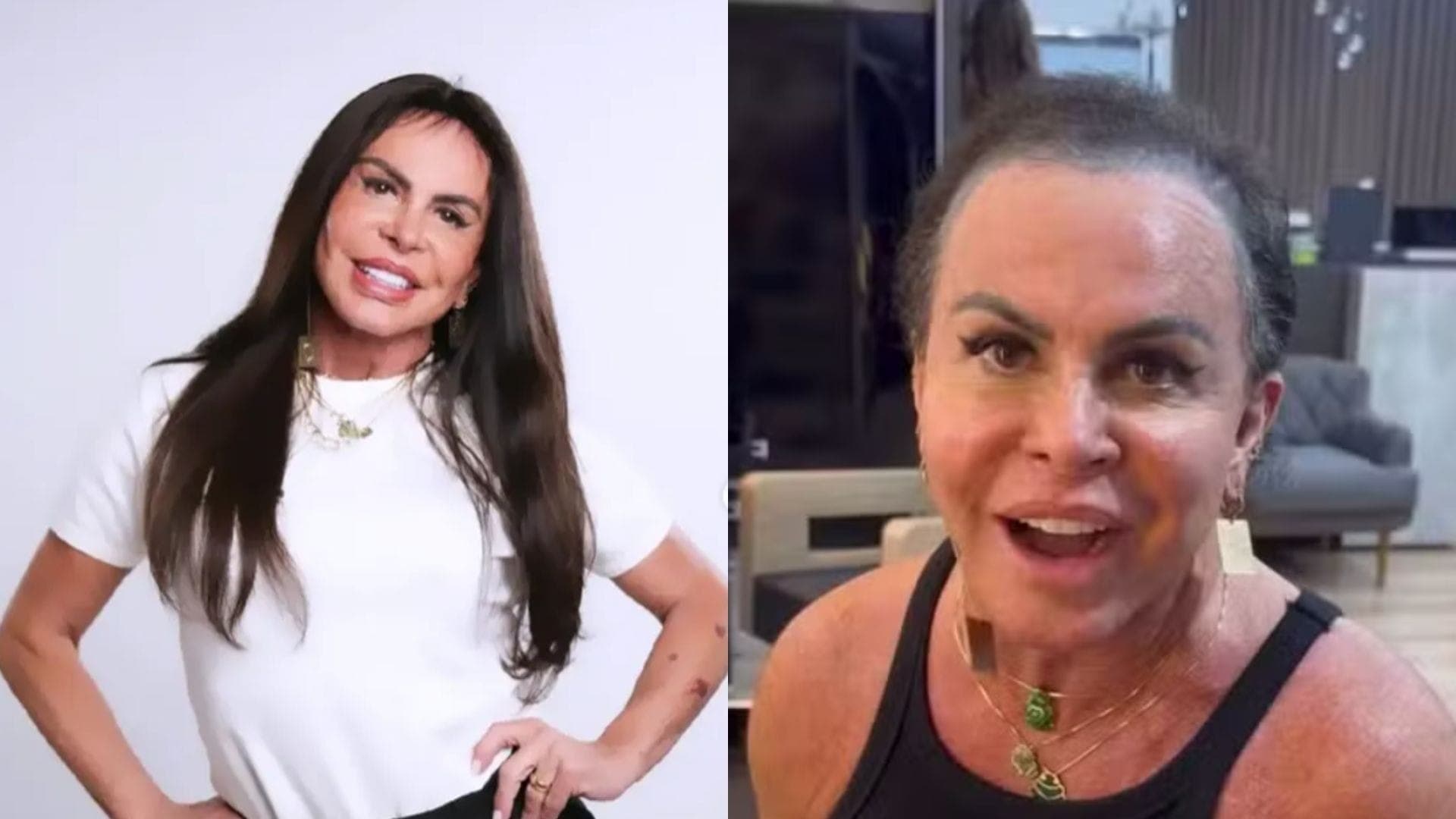 Gretchen convive com alopecia